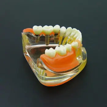 Демонстрационный Зубной протез, Реставрация Зубных имплантатов, Модель Съемного моста #6006